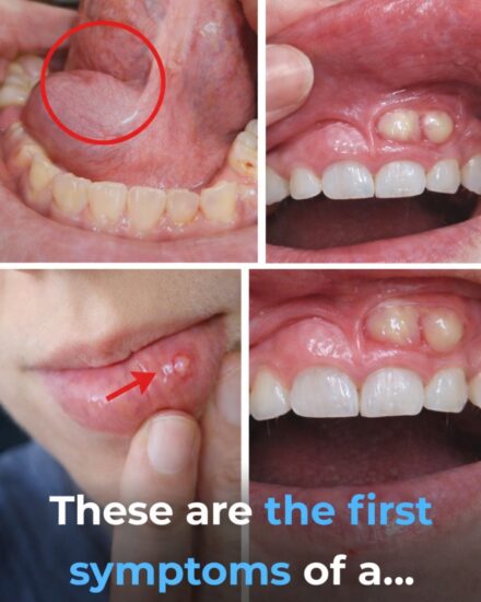7 Early Signs of Oral Cancer You Should Never Ignore