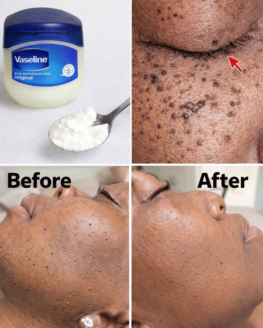 Those Stubborn Little White Bumps: Understanding Milia and Safe Ways to Improve Your Skin’s Appearance